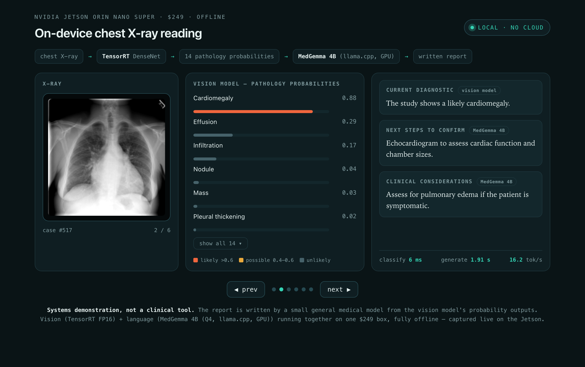 The reading station on a cardiomegaly case: cardiomegaly scores 0.88 (likely). The findings read 'likely cardiomegaly', the next step is an echocardiogram, and the clinical consideration is to assess for pulmonary edema if the patient is symptomatic.